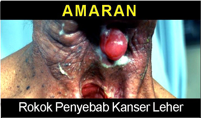 Malaysia 2008 Health Effects Other - neck cancer, lived experience, gross (front)